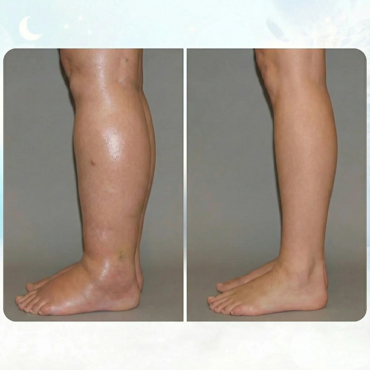 AVANI - Cura la dermatite da stasi a casa con l'EMS